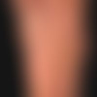 Psoriasis palmaris et plantaris: mixed type with keratotic plaques, dyshidrotic vesicles and pust...