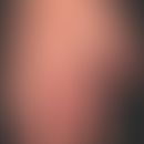 Psoriasis arthropathica : Acral accentuated psoriasis vulgaris with severe nail dystrophy and dis...
