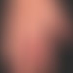 Psoriasis arthropathica : Acral accentuated psoriasis vulgaris with severe nail dystrophy and dis...