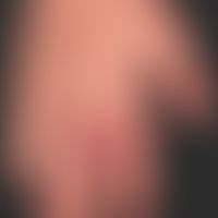 Psoriasis arthropathica : Acral accentuated psoriasis vulgaris with severe nail dystrophy and dis...