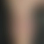 Psoriasis arthropathica: single (only on the thumb), complete, crumbly onychodystrophy (psoriatic...