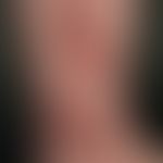 Nummuläre Dermatitis: chronisch aktive, seit&nbsp;mehreren Monaten bestehende, ca. 6 cm große,&nb...