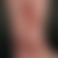 Nummular dermatitis: chronically active, for several months existing, approx. 6 cm large, raised,...