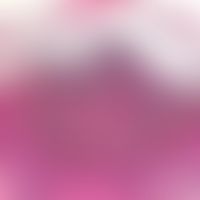 Pustulose akute generalisierte exanthematische: eingekreist die subkorneale Pustel mit neutrophil...
