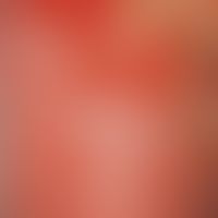 Pustulose, akute generalisierte exanthematische.&nbsp;Großflächige Ablösung der Haut, randständig...