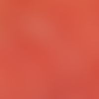 Pustulose, akute generalisierte exanthematische.&nbsp; Bizarr konfigurierte (subkorneale), leicht...