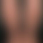 Purpura pigmentosa progressiva: etiologically unexplained (medication?) pronounced clinical pictu...