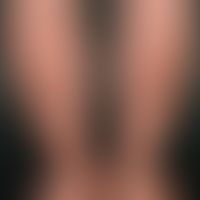 Purpura pigmentosa progressiva: ätiologisch ungeklärtes (Medikamente?) ausgeprägtes, seit mehrere...