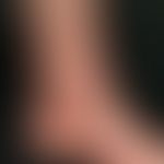 Purpura pigmentosa progressiva: aetiologically unexplained (medication?) pronounced clinical pict...