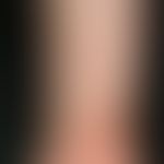 Purpura pigmentosa progressiva: aetiologically unexplained (medication?) pronounced clinical pict...