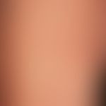 Purpura pigmentosa progressiva. irregularly configured, reddish-brownish spots with petechiae tha...
