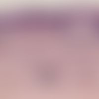 Purpura pigmentosa progressiva: Dermis slightly edematous loosened. vertical arrow indicates a br...