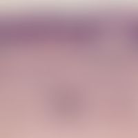 Purpura pigmentosa progressiva: Intact epithelium, sparse, perivascularly compressed round cell i...