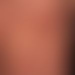 Purpura pigmentosa progressica (type: Purpura anularis teleangiectodes): brown-red anular, also c...