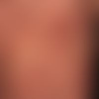 Purpura pigmentosa progressica (Typ: Purpura anularis teleangiectodes): braun-rote anuläre, auch ...