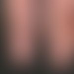Purpura jaune d'ocre: flächige, unscharf begrenzte, &nbsp;vollkommen asymptomatische,&nbsp;gelb-b...