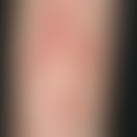 Purpura thrombozytopenische: strichförmige, frische&nbsp;Hautblutungen (diaskopisch nicht wegdrüc...