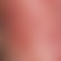 Purpura, thrombozytopenische: buntes Bild mit frischen, punktförmigen, roten&nbsp;Einblutungen, s...
