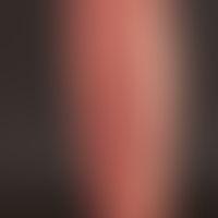 Purpura thrombozytopenische: An beiden Unterschenkeln mit Betonung der Streckseiten bestehende, h...