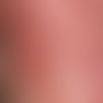 Thrombocytopenic skin lesions: detailed view with a colourful picture of fresh and older petechia...