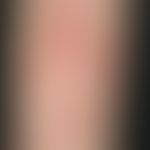 Thrombocytopenia skin changes: detailed view
