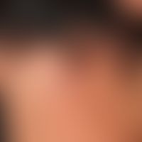Alopecia areata: Ophiasis type with an arched limitation of the hair loss line in the neck (rathe...