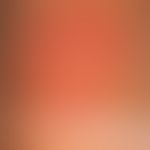 Zellulitis, eosinophile (Frühphase): deutlicher Pruritus und dolentes Brennen seit mehreren Tagen...