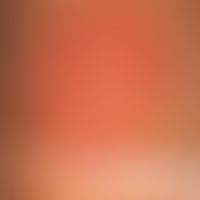 Cellulitis, eosinophilic. early phase: Clear pruritus and dolent burning for several days. The di...