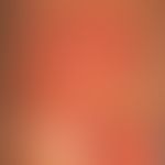 Zellulitis eosinophile: Detailabbildung mit apfelsinenschalenartig gepunzter Oberfläche der zentr...