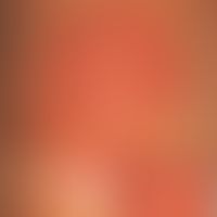 Zellulitis eosinophile: Detailabbildung mit apfelsinenschalenartig gepunzter Oberfläche der zentr...