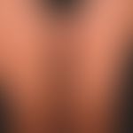 Acute urticaria: Acute exanthema with multiple red wheals localized on the trunk and extremities,...