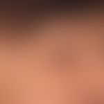 Angioedema of the eyelids: acute, not itchy swelling of the eyelids of both eyes, cause remained ...