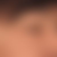 Angioödem der Lider: akute, nicht juckende Schwellung der Lider beider Augen. Ursache blieb unklar.
