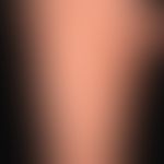Acute spontaneous urticaria: acutely occurring, itchy exanthema with anular and circine wheals (p...