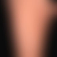 Acute spontaneous urticaria: acutely occurring, itchy exanthema with anular and circine wheals (p...
