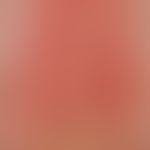 Urticaria factitia: wheal formation in the scratch marks caused by scratching, conspicuous "peau ...