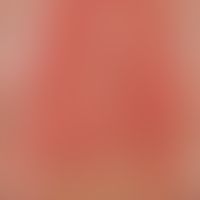 Urticaria factitia: durch Kratzen aktu ausgelöste Quaddelbildung in den Kratzspuren. Aufflällige ...
