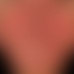 Rosacea papulopustulosa: disseminated, intermittent papules and pustules that persist for weeks o...