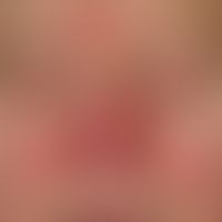 Rosacea papulo-pustulosa: Rezidivierende zentrofaziale Pustelbildungen
