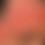 Rosacea papulopustulosa: detailed view of the changes in the forehead.
