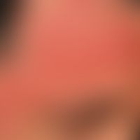 Rosacea papulopustulosa: Detailaufnahme der Stirnveränderungen.
