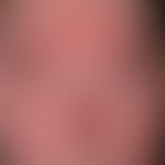 rosacea papulopustulosa: centrofacially localized redness, inflammatory papules and pustules. inf...