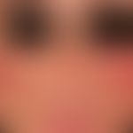 Rosacea papulopustulosa: grouped, inflammatory reddened papules and pustules that persist for wee...