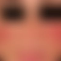Rosacea papulopustulosa: gruppierte, entzündlich gerötete, schubweise auftretende über Wochen per...