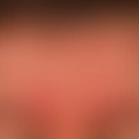 Dermatitis, seborrhoische des Erwachsenen: teils kleinfleckige, teils flächige unscharf begrenzte...