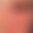 Rosacea fulminans: akuter Schub mit zahlreichen, schmerzhaften&nbsp;z.T. konfluierten Pusteln. Ke...