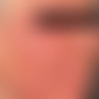Rosacea fulminans: akuter Schub mit zahlreichen, schmerzhaften&nbsp;z.T. konfluierten Pusteln. Ke...