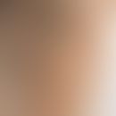 Erythrasma: scharf begrenzte, flächenhafte nicht juckende bräunliche Verfärbung im Bereich der Ac...