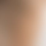 Erythrasma: scharf begrenzte, flächenhafte nicht juckende bräunliche Verfärbung im Bereich der Ac...