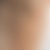 Erythrasma: scharf begrenzte, flächenhafte nicht juckende bräunliche Verfärbung im Bereich der Ac...